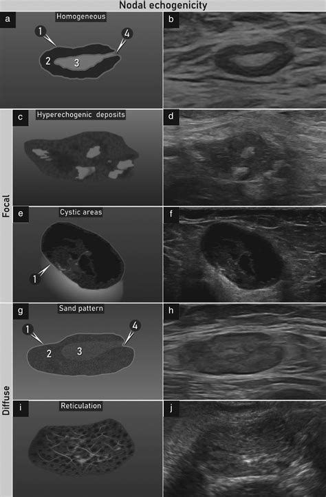 Terms, definitions and measurements to describe sonographic features of ...