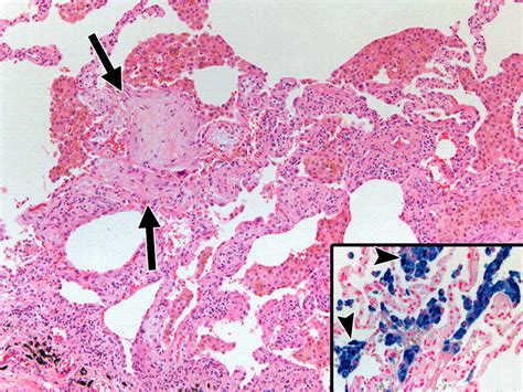 Vasculitis Pulmonar