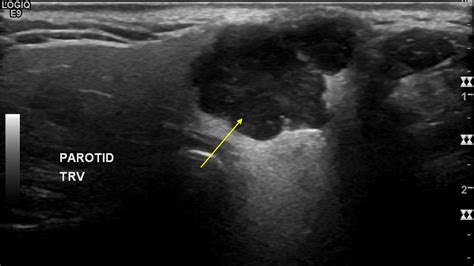 Parotid Gland Tumor Ultrasound