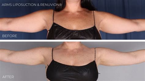 Arms Liposuction | Omaha Liposuction by Imagen