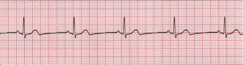 Electrocardiogram (ECG)