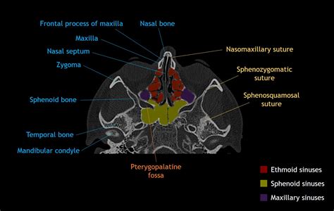 Sphenoid Bone Labeled