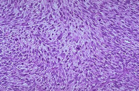 Pathology Outlines - Leiomyosarcoma