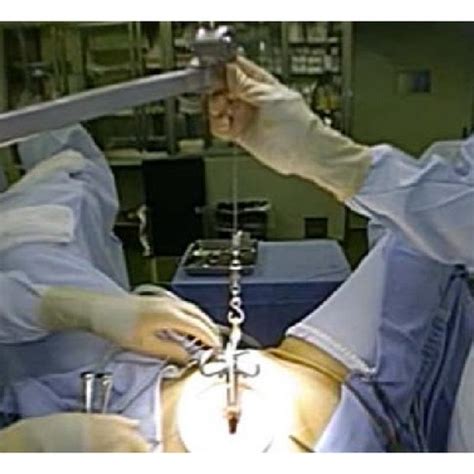 A single-port laparoscopic view showing the necrotized subserosal myoma ...