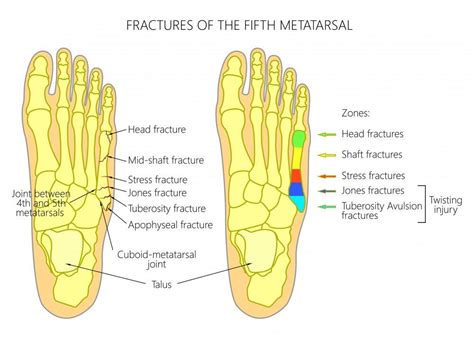 Metatarsal Bone Fracture