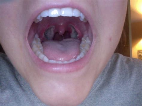 Tonsillectomy Scabs Pictures – Tonsillectomy