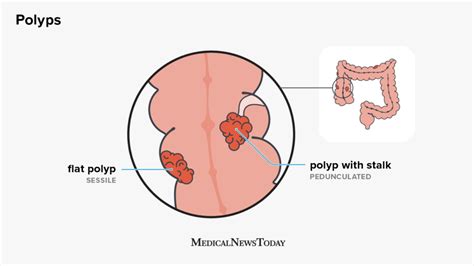 Sessile polyps: Causes, risk factors, and treatment