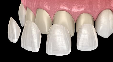 Dental veneers - Types, Uses & Process - Safar Medical