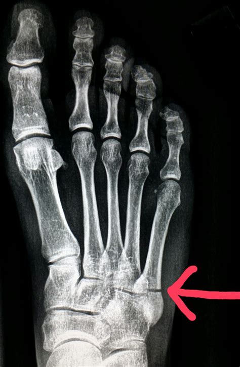 5th metatarsal fracture classification - denisdude