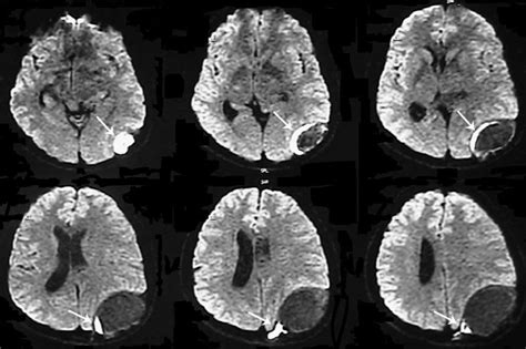 diffusion-weighted imaging sequences showing diffusion restriction in ...