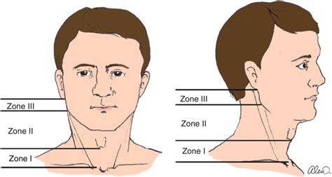 Chapter 12 – Neck Trauma | Anesthesia Key