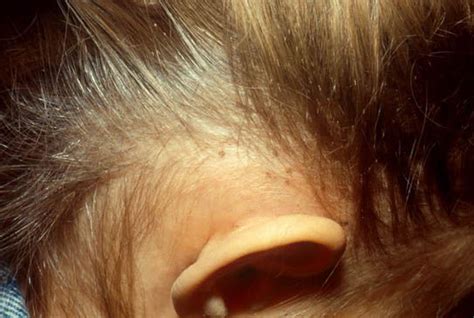 Lice: Pictures, Symptoms, FAQs