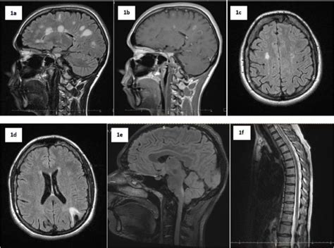 Differential diagnosis of multiple sclerosis and other inflammatory CNS ...