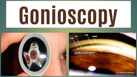 Gonioscopy || Gonioscopy Test || Gonioscopy View || How to see Drainage ...