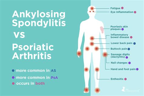 Ankylosing Spondylitis vs. Psoriatic Arthritis: Differences in Symptoms ...