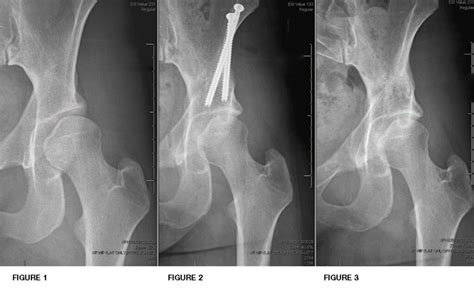 Periacetabular Osteotomy (PAO) - CU Sports Med Hip Clinic