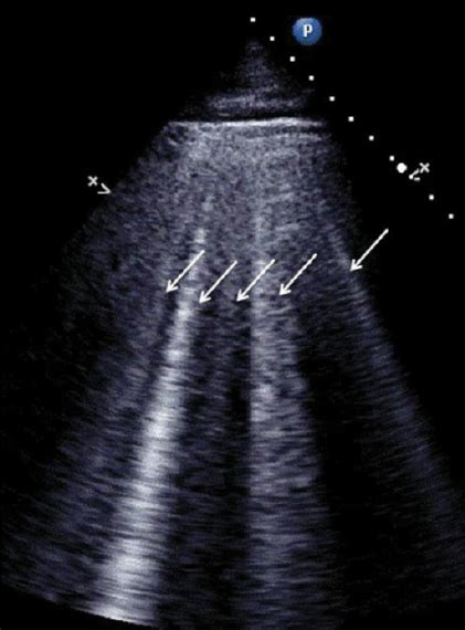 Transthoracic lung ultrasound reveals multiple sonographic B-lines ...