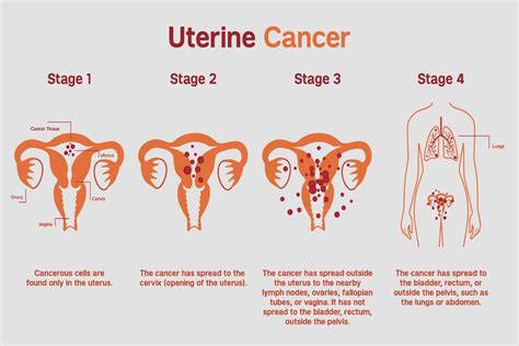 Uterine (Endometrial) Cancer: Types, Risk Factors, Symptoms & Treatment ...