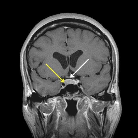 MRI Studies of the Patient's Pituitary Gland MRI of the pituitary gland ...