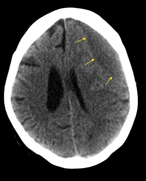 Chronic subdural haematoma - Radiology at St. Vincent's University Hospital