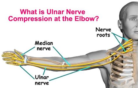 What is Ulnar Nerve Compression at the Elbow? | Ulnar nerve, Ulnar ...