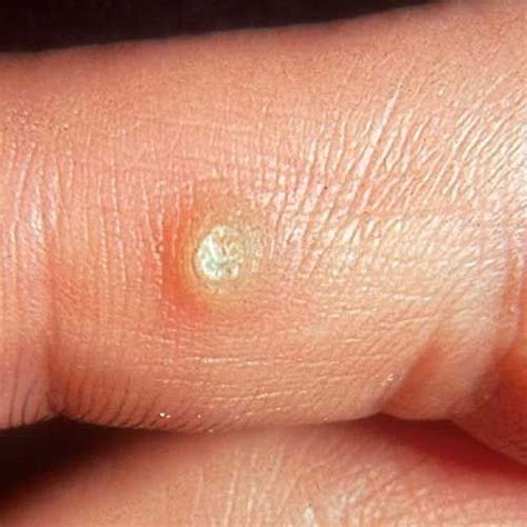 Pin on Warts Health