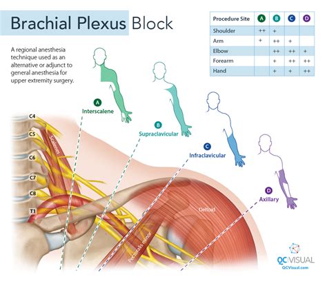 Brachial Plexus Nerve Block Location