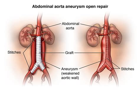 Abdominal Aortic Aneurysm - Stanford Medicine Children's Health