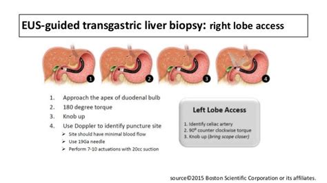 Liver Biopsy Procedure