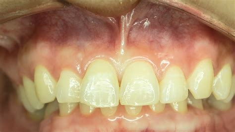 Labial Frenulum Normal