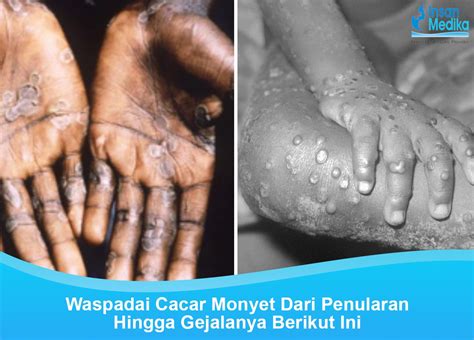 Waspadai Cacar Monyet Dari Penularan Hingga Gejalanya Berikut Ini