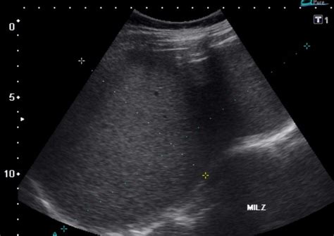 Splenic Vein On Ultrasound