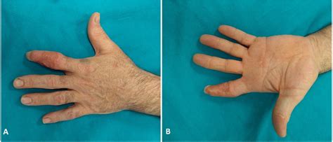 Treatment of finger degloving injury with acellular dermal matrices ...