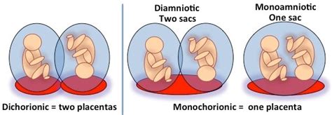 Complicated Monochorionic Twins | Johns Hopkins Center for Fetal ...