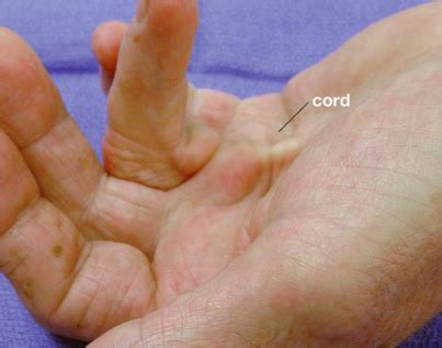 Dupuytren’s Contracture – Carolyn Yang, MD