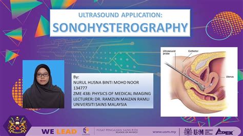 Ultrasound Application: Sonohysterography - YouTube