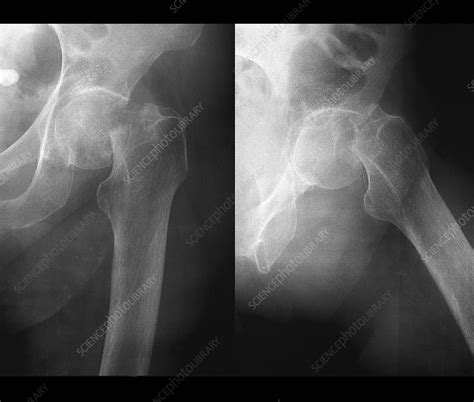 Fractured hip joint, X-ray - Stock Image - C053/0008 - Science Photo ...