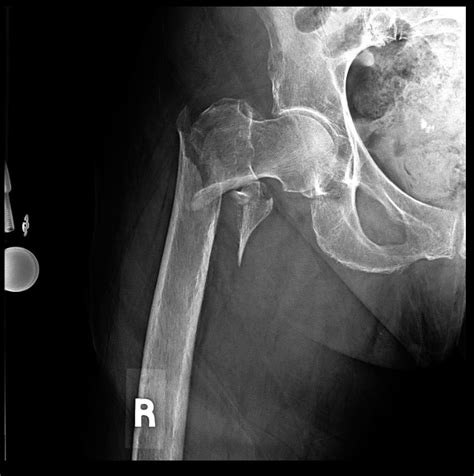 Pertrochanteric Femur Fracture