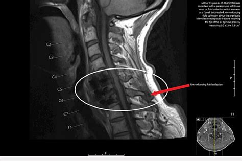 MRI scan of C-spine as of September 29, 2020 indicates a small ...