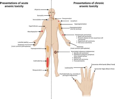 Cutaneous manifestations and treatment of arsenic toxicity: A ...