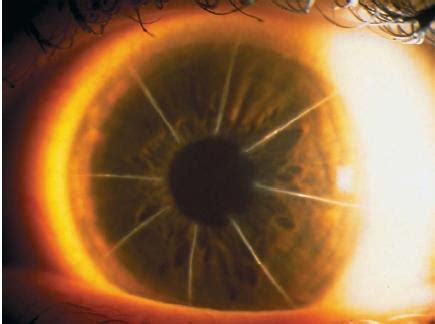 Options to improve vision after radial keratotomy (pizza pie) surgery ...