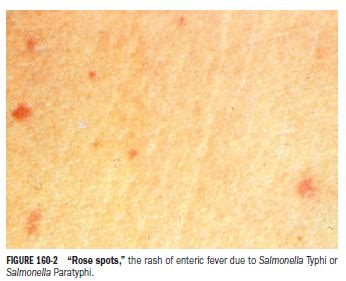 Typhoid Rash Rose Spots