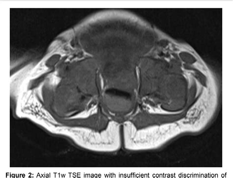 Figure 2 from MRI in Hip Dysplasia: How to Shorten your MR-Protocol ...