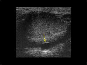 Urinary Tract and male reproductive system | 2.3 Scrotum : Case 2.3.2 ...