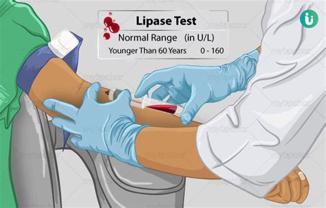 Lipase Test: Procedure, Purpose, Results, Cost, Price