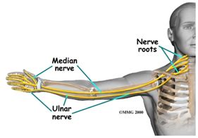 Pinched Nerve Treatment - Neck & Arm Pain Therapy