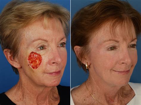 Skin Cancer Reconstruction Photos | Naples, FL | Patient 12033