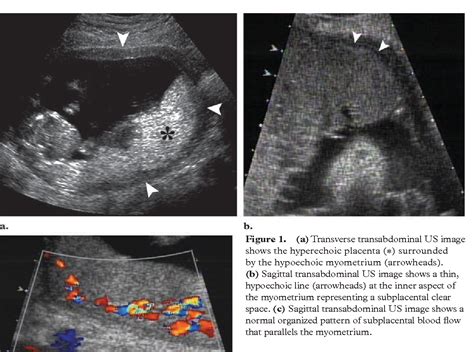 Figure 1 from Placenta accreta: spectrum of US and MR imaging findings ...