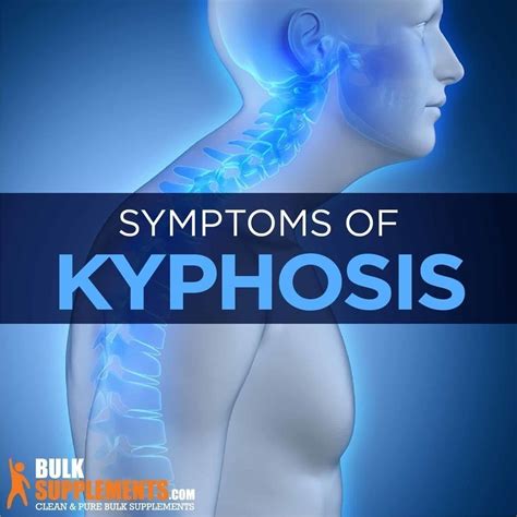 Tablo | Read 'Kyphosis: Symptoms, Causes & Treatment' by