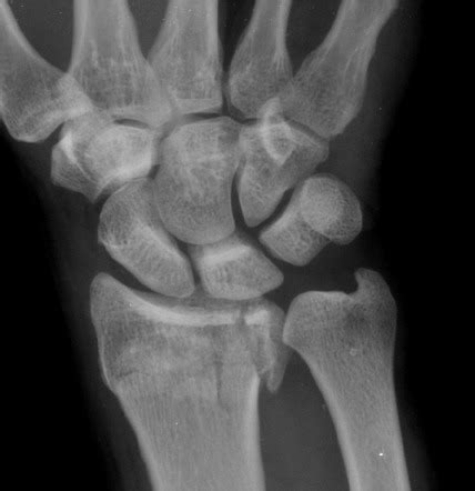 Distal radius fractures with intra-articular component | Radiology Case ...